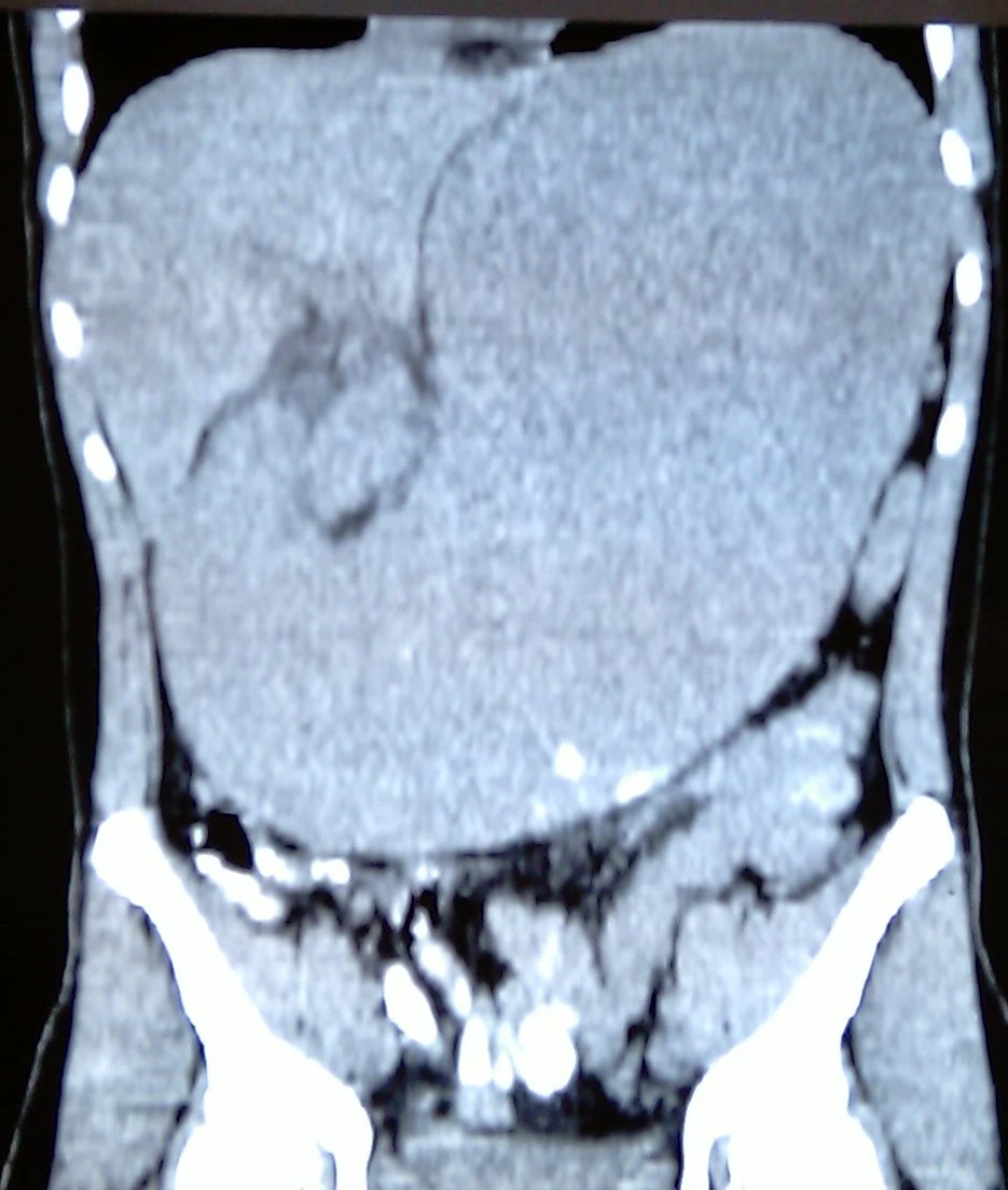 ENORMOUS GASTRIC DILATATION - SMA SYNDROME