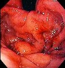 EROSIVE GASTRITIS