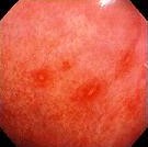 EROSIVE GASTRITIS