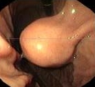GASTRIC STROMAL TUMOR
