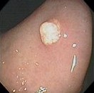 GASTRIC XANTHELASMA