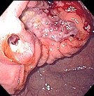 GASTRIC CANCER