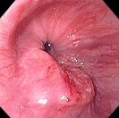 GASTRIC CANCER