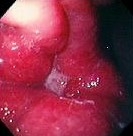GASTRIC CANCER