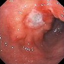 GASTRIC CANCER