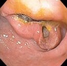 GASTRIC CANCER