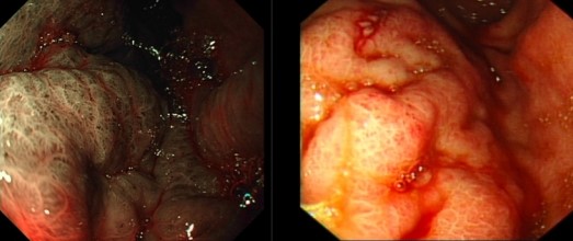 GASTRIC AMYLOIDOSIS