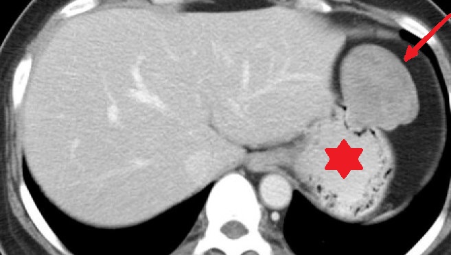 GASTRIC ANGIOMYXOMA