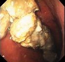 GASTRIC BEZOAR