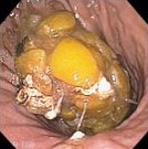 GASTRIC BEZOAR