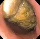 GASTRIC BEZOAR