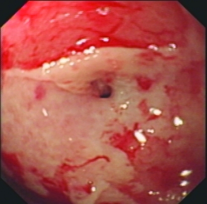 GASTRIC BURNS