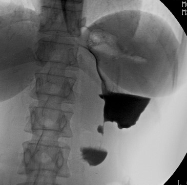 GASTRIC BURNS