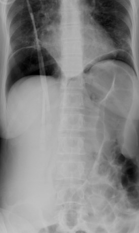 GASTRIC BURNS