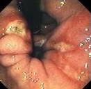 GASTRIC CAMERON ULCER