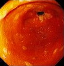 GASTRIC CANDIDA