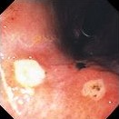 GASTRIC CAMERON ULCER