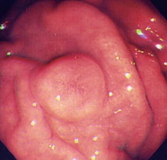GASTRIC CARCINOID