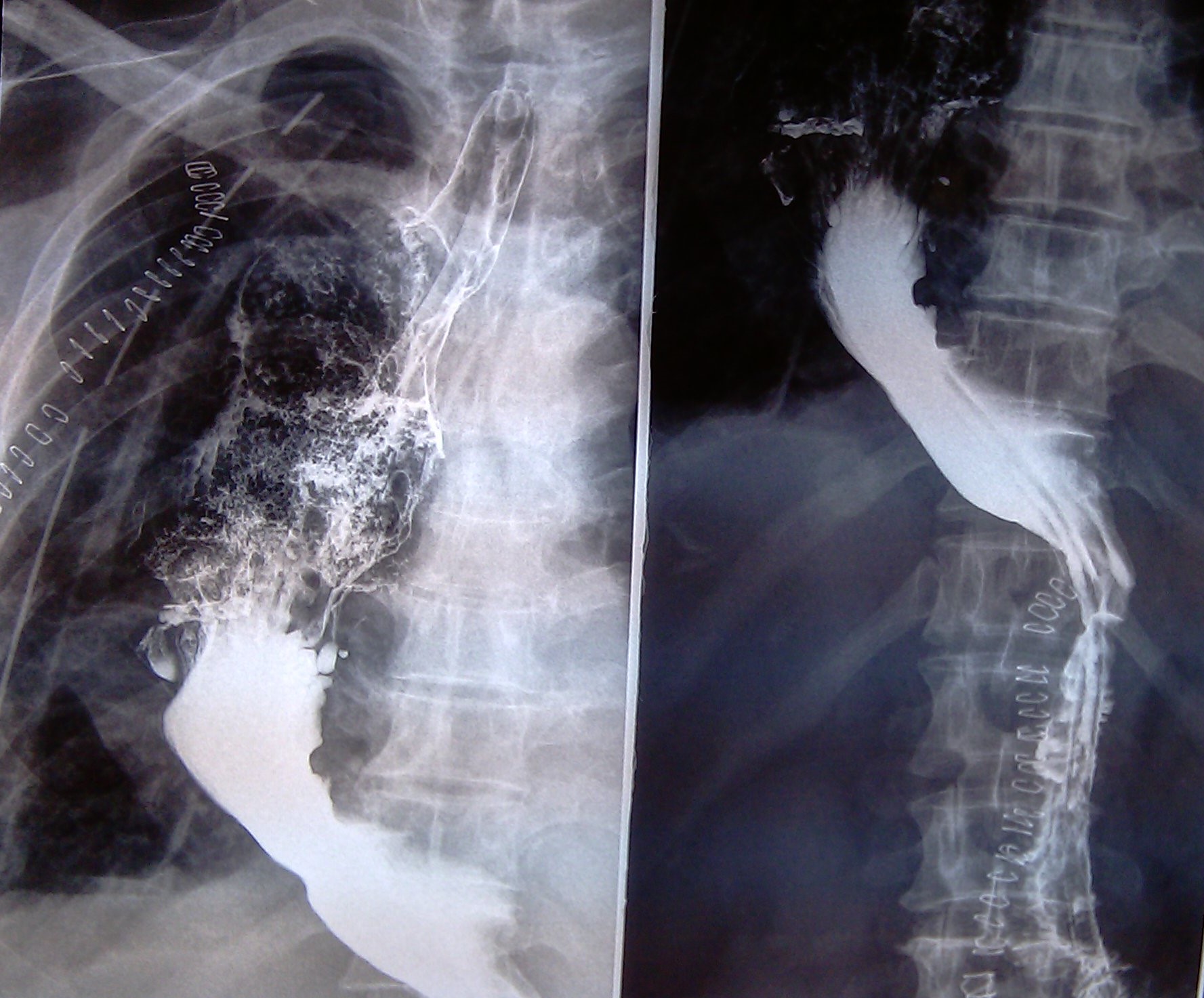 ESOPHAGECTOMY - GASTRIC CONDUIT
