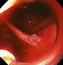 GASTRIC DIEULAFOY LESION