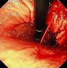 GASTRIC DIEULAFOY LESION 