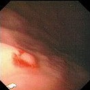 GASTRIC DIEULAFOY LESION
