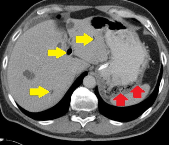 GASTRIC EMPHYSEMA