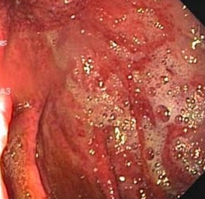 GASTRIC EMPHYSEMA