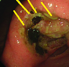 GASTRIC ENDOCRINE CELL CARCINOMA