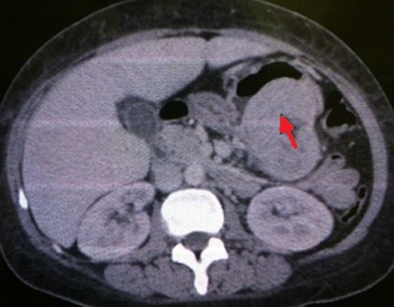 GASTRIC FIBROMYOBLASTIC TUMOR