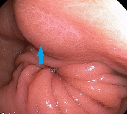 GASTRIC FIBROMYOBLASTIC TUMOR