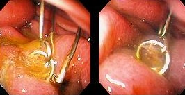 GASTRIC FOREIGN BODY