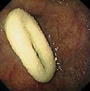 GASTRIC FOREIGN BODY