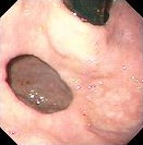 GASTRIC FUNDIC DIVERTICULUM