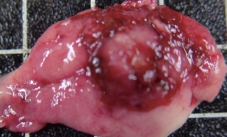 GASTRIC GIST