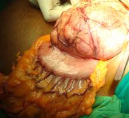 GASTRIC GIST