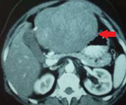 GASTRIC GIST