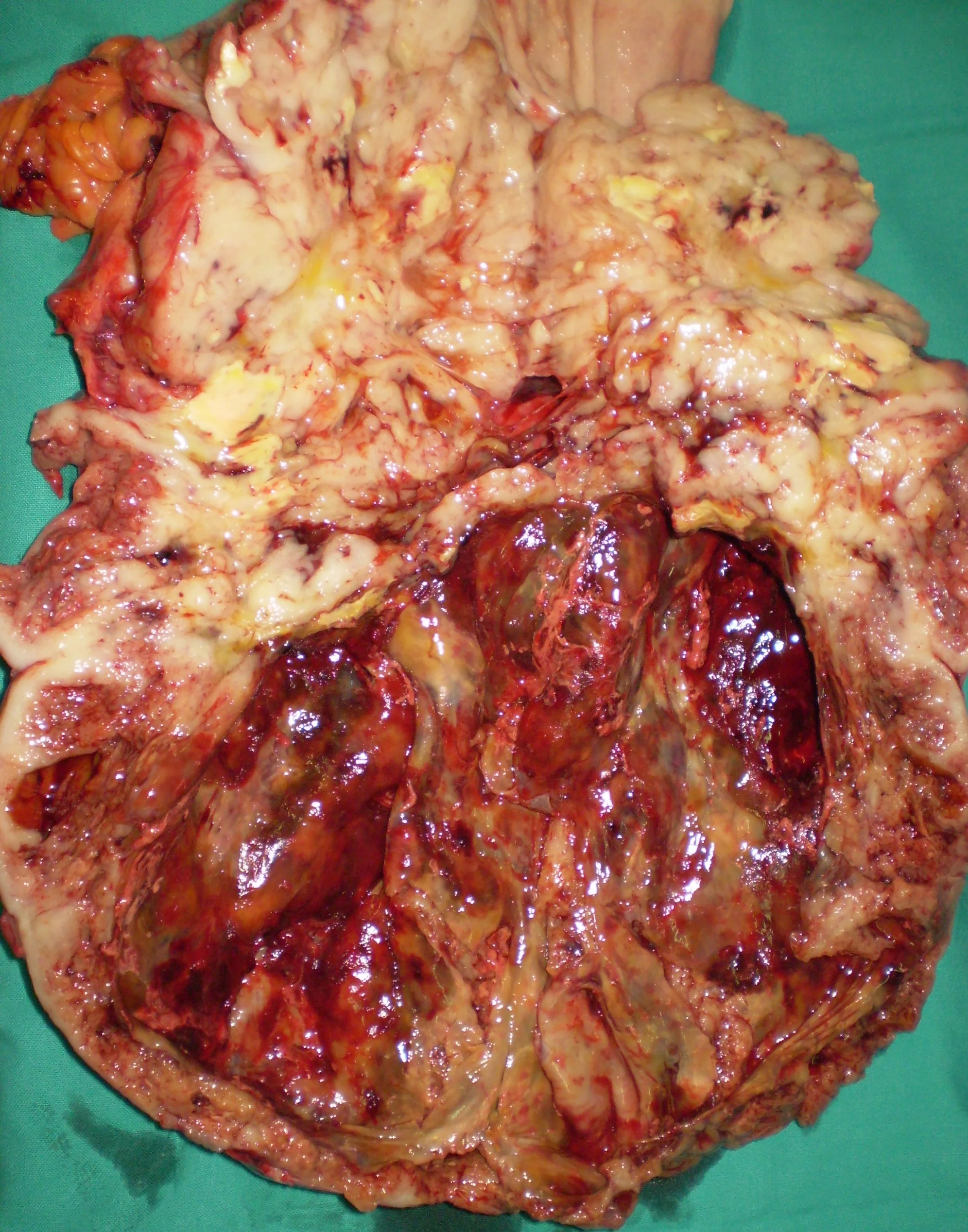 GASTRIC GIST