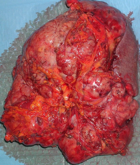 HUGE GASTRIC GIST
