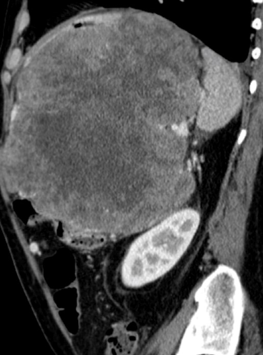 HUGE GASTRIC GIST