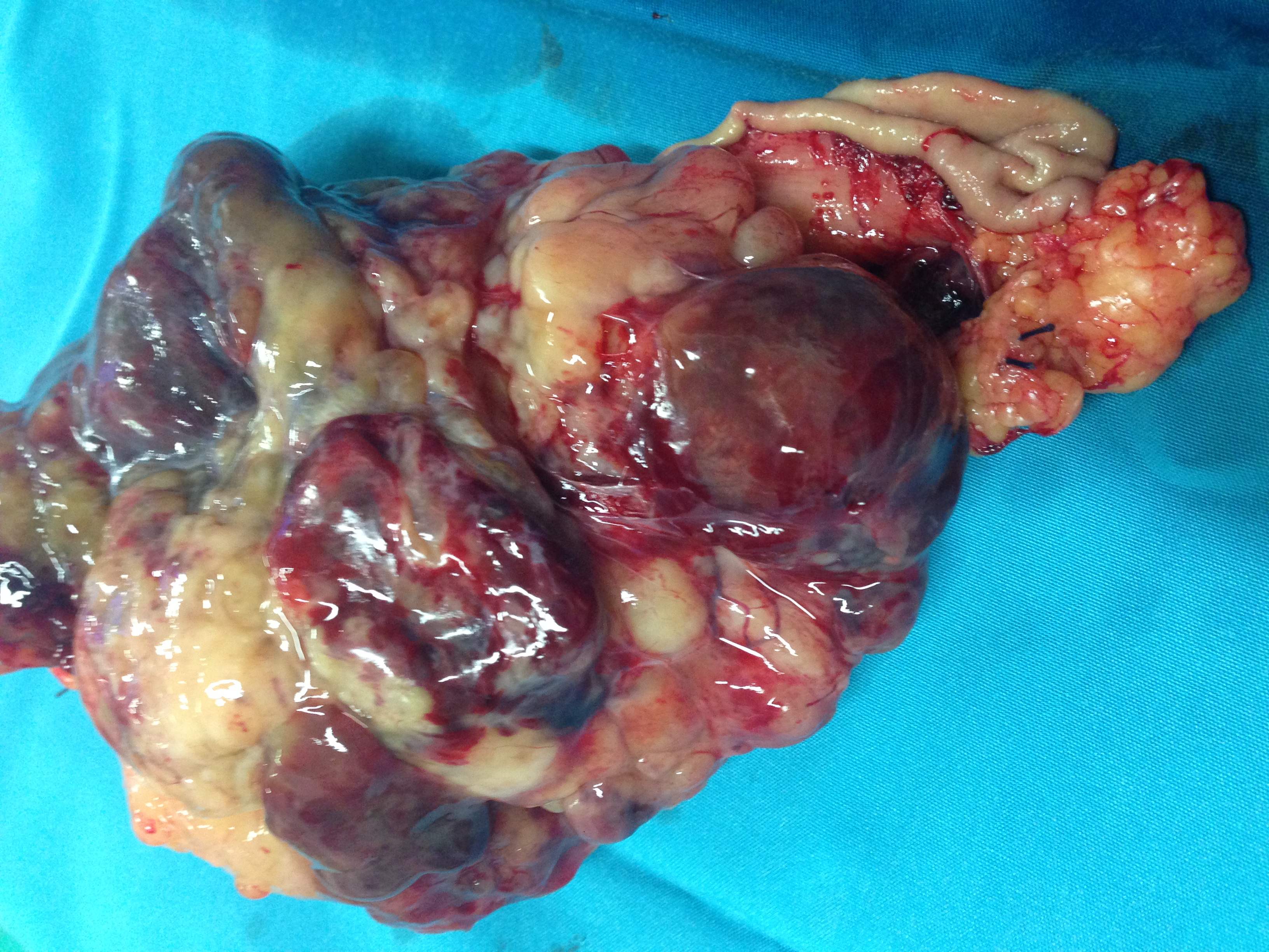 GASTRIC GIST