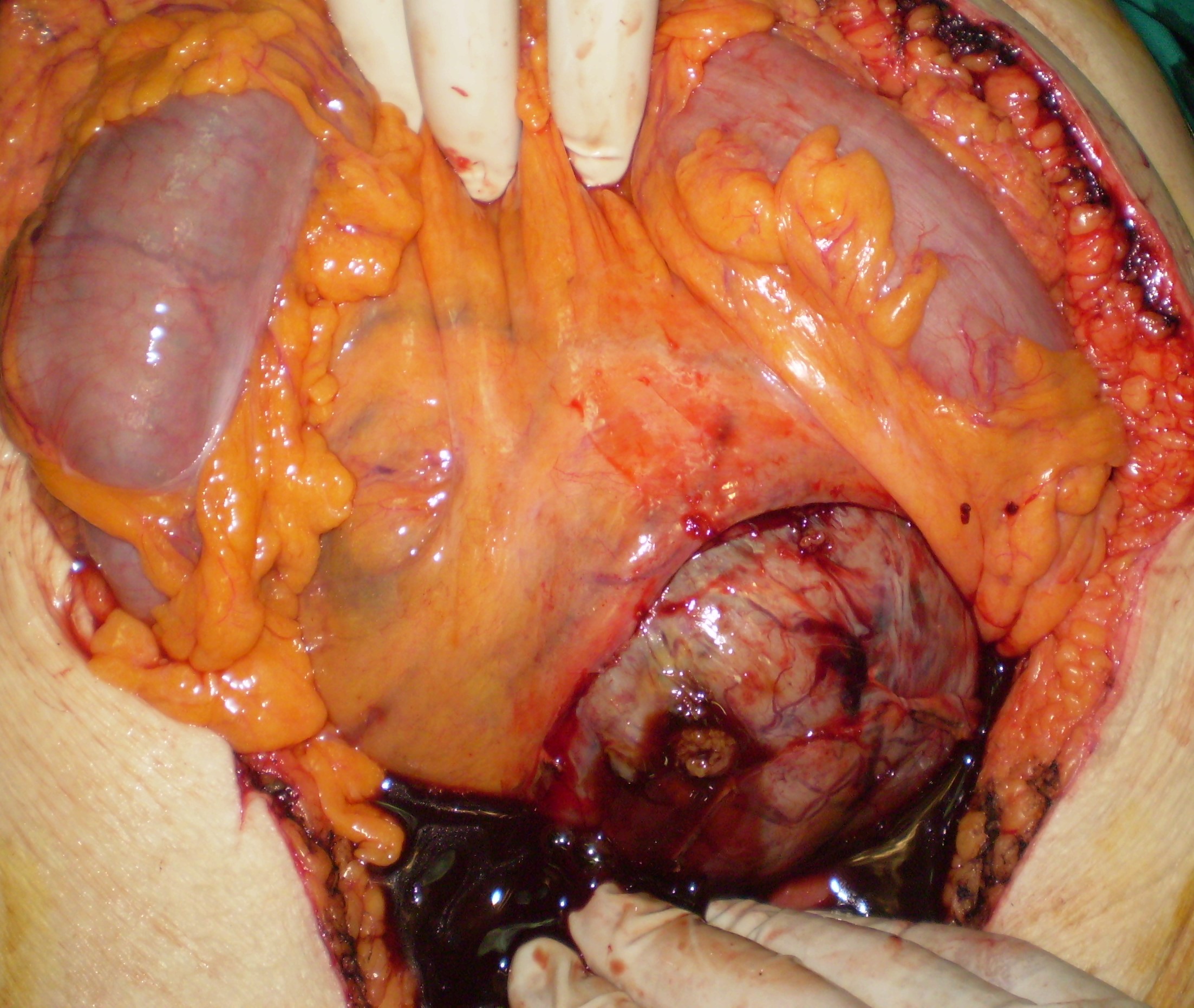 GASTRIC GIST