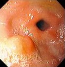 GASTRIC INFLAMMATORY FIBROID POLYP