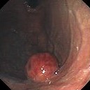 GASTRIC LEIOMYOMA