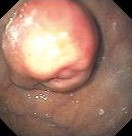 GASTRIC LEIOMYOMA