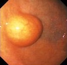 GASTRIC LIPOMA