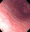 GASTRIC LYMPHOID NODULARITY