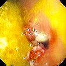 GASTRIC OUTLET OBSTRUCTION