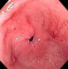 GASTRIC SARCOIDOSIS
