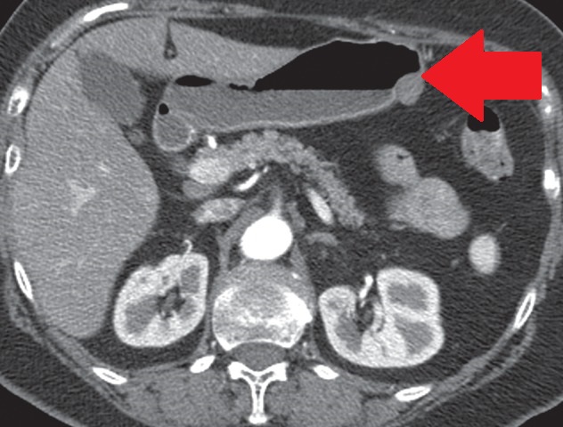 GASTRIC SCHWANNOMA